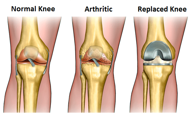 Knee Arthiritis